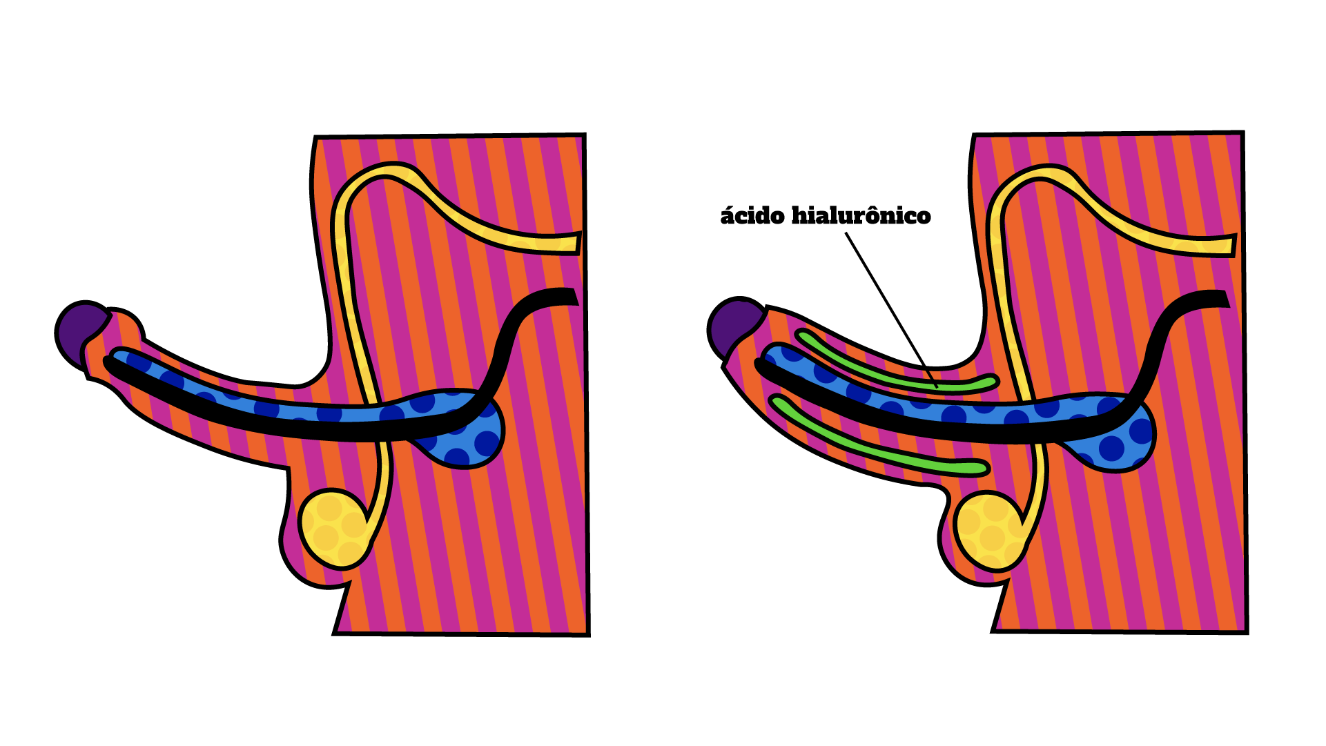 ilustração de bioplastia e engrossamento