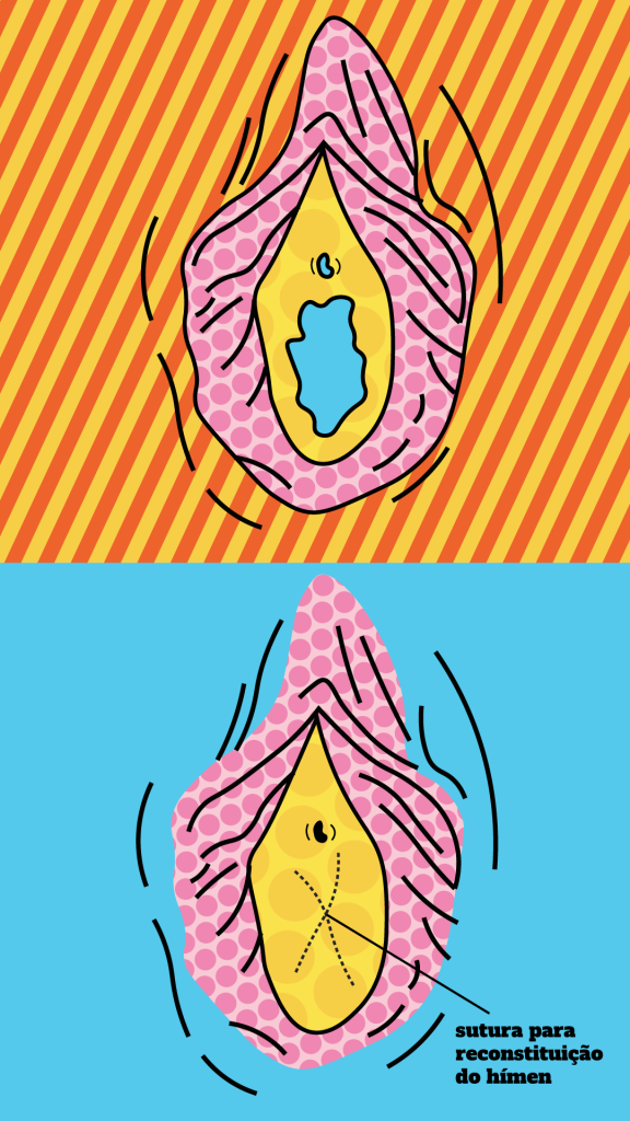ilustração de himenoplastia