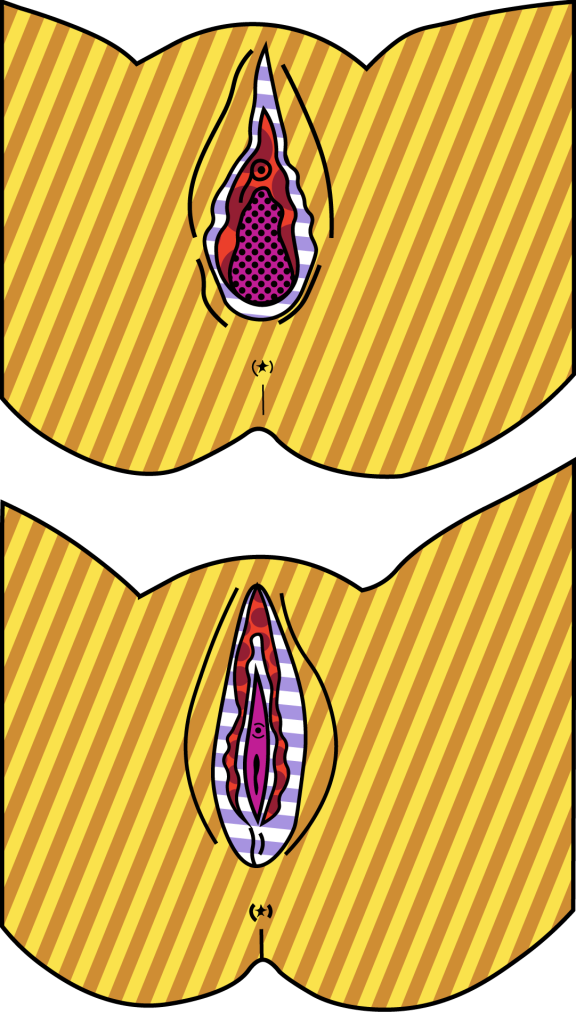 ilustração de vaginoplastia